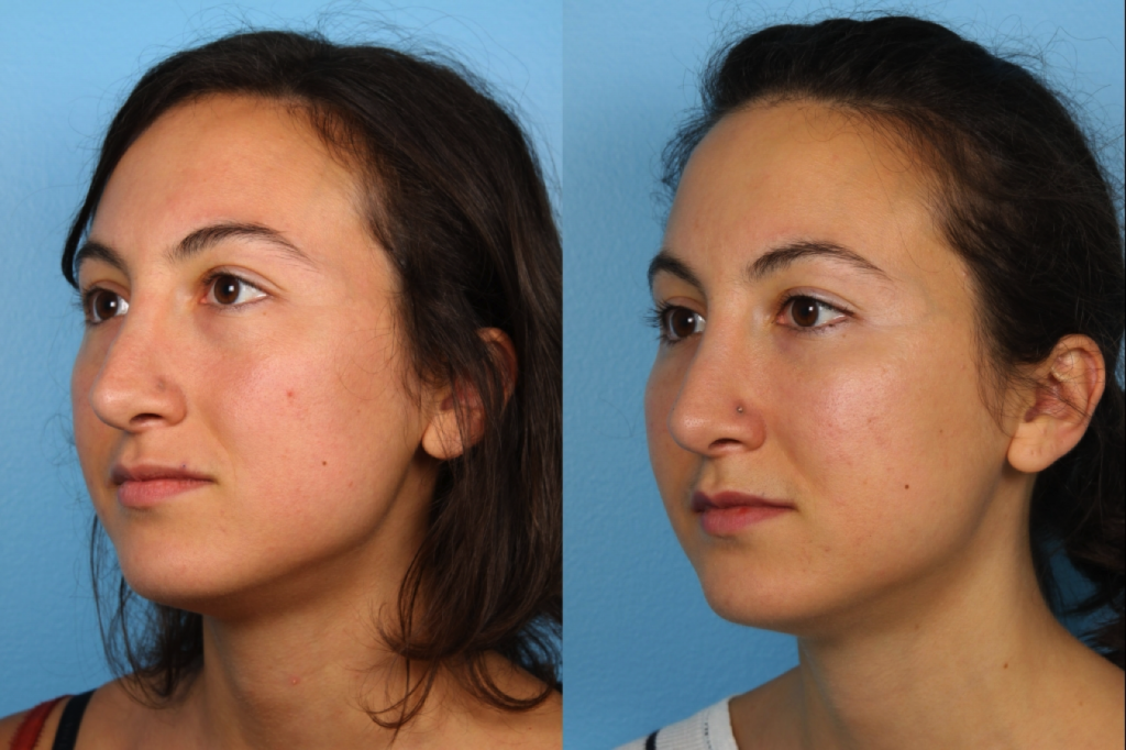 Fat Transfer and Injection | Northwestern Facial Plastic ...