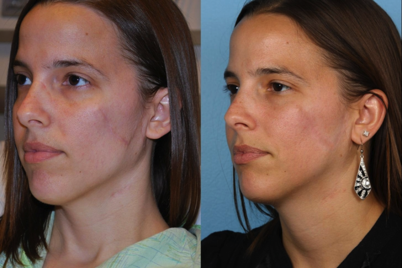 Before & After Pictures | Scar Revision Chicago, IL |Dr. Sidle
