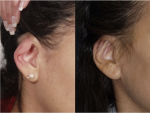 Otoplasy (Ear Pinning)