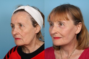 Facelifts and Necklifts