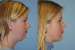 Chin and Submental Liposuction