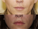 Botox and Injectables