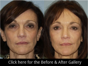 Chicago Eyelid Lift Surgery