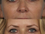 Blepharoplasty Before and After Photo
