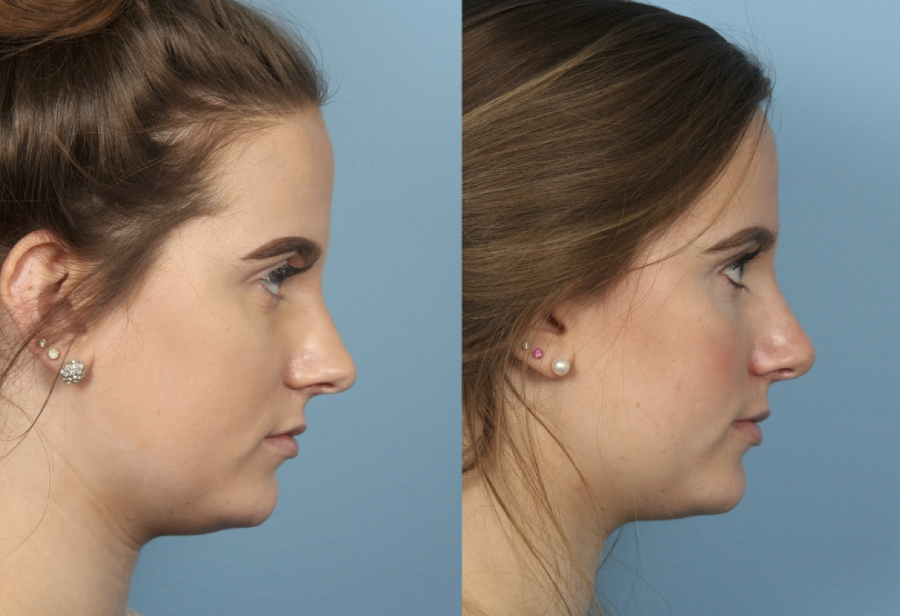 Chin Implant Chicago | Cheek Augmentation Surgery |Dr. Sidle