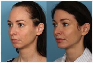 Hairline lowering Surgery