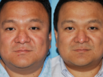 Rhinophyma- Before and After Photo