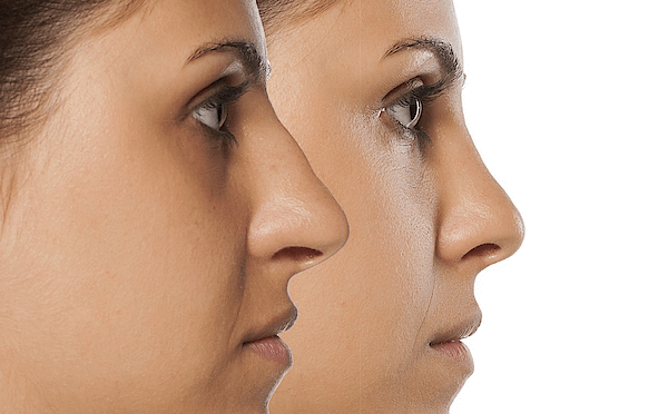 Dr Trussler Rhinoplasty Austin