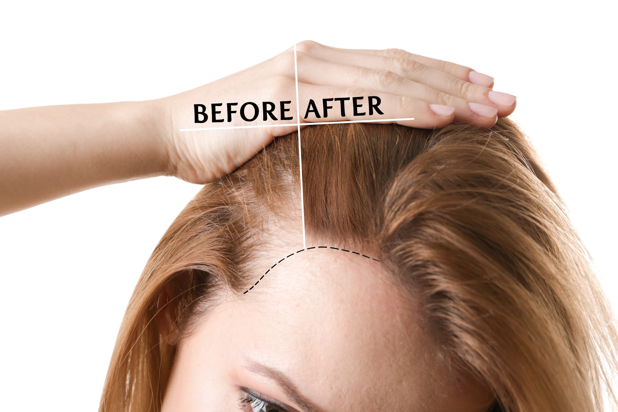 Everything You Need to Know About Forehead Reduction and Hairline Lowering  Surgery |Dr. Sidle