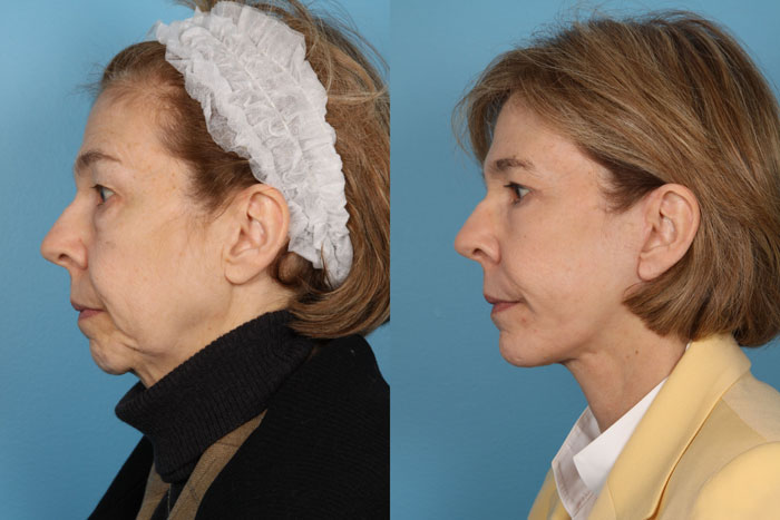 Neck lift Surgery Before & After Photo