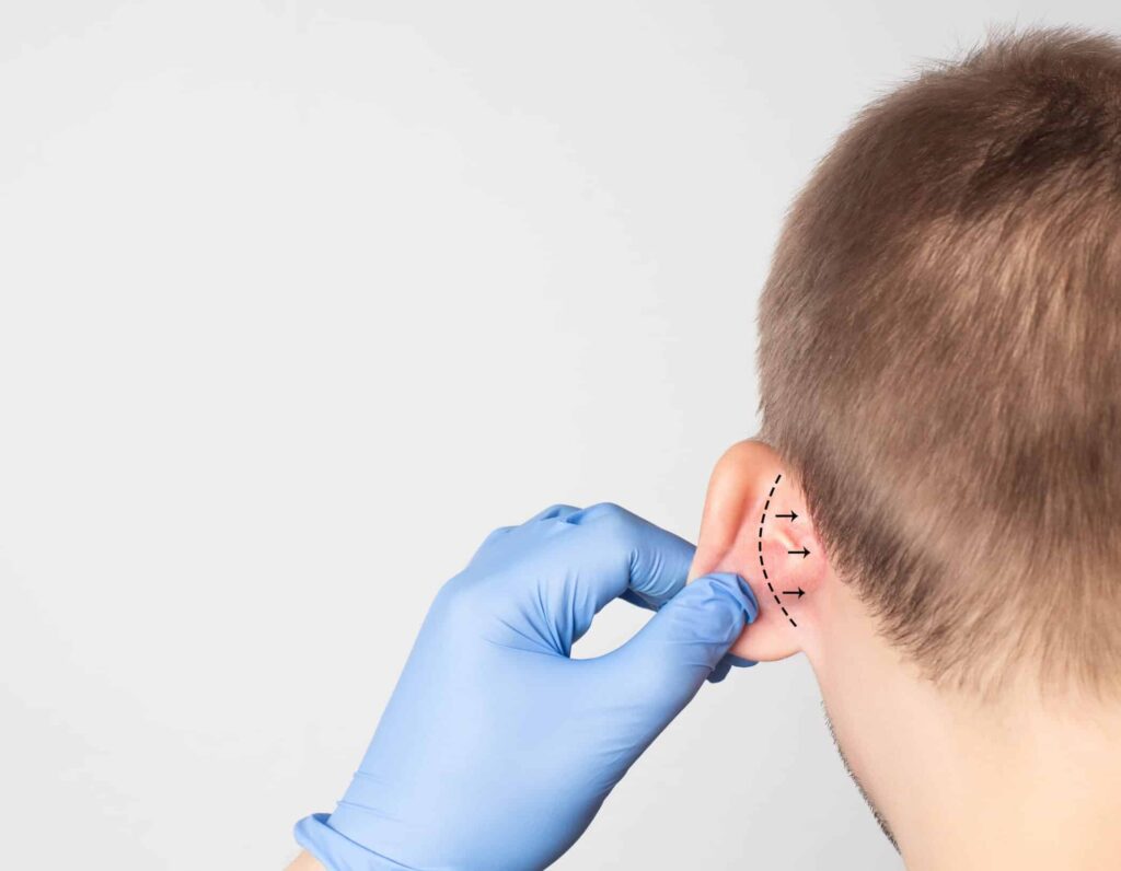 otoplasty