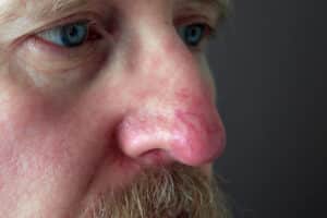 Rhinophyma