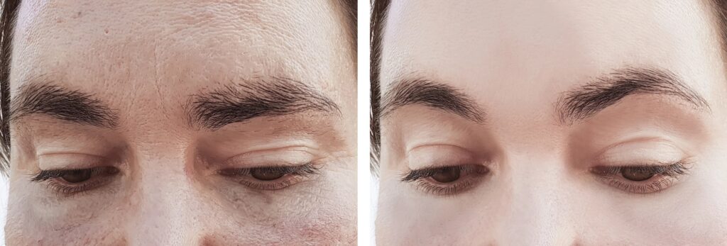 combine browlift with botox