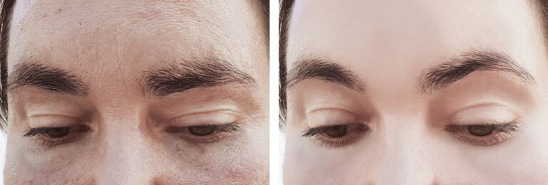 combine browlift with botox