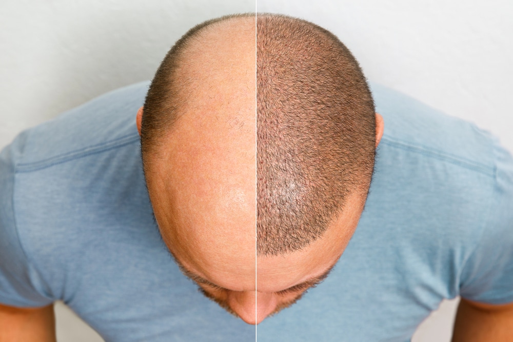 forehead reduction vs hair transplant