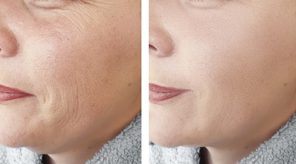 liquid facelift