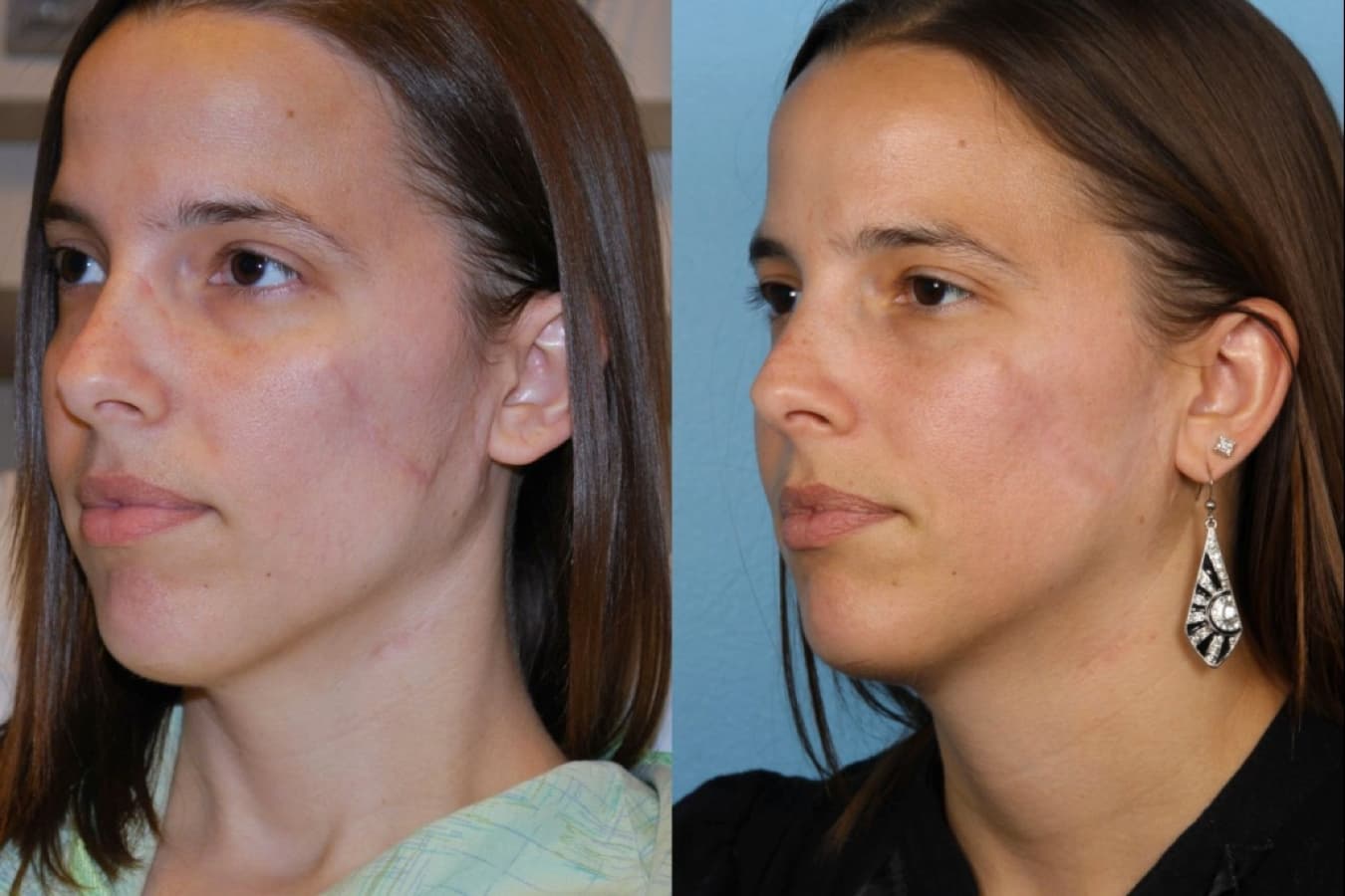 Scar Revision