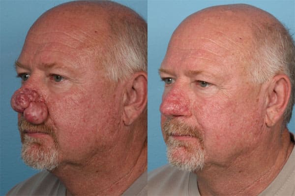 Rhinophyma