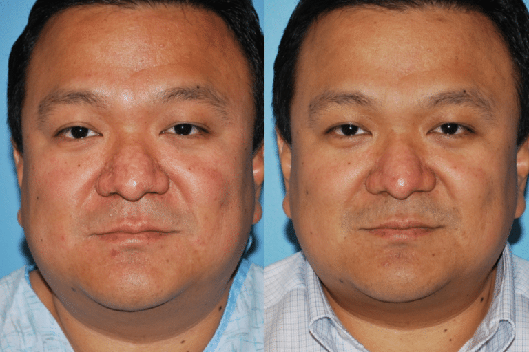 Rhinophyma
