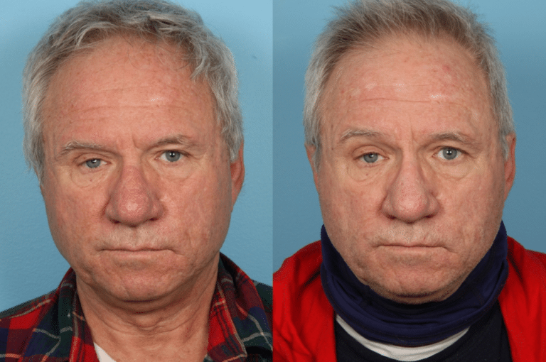 Rhinophyma
