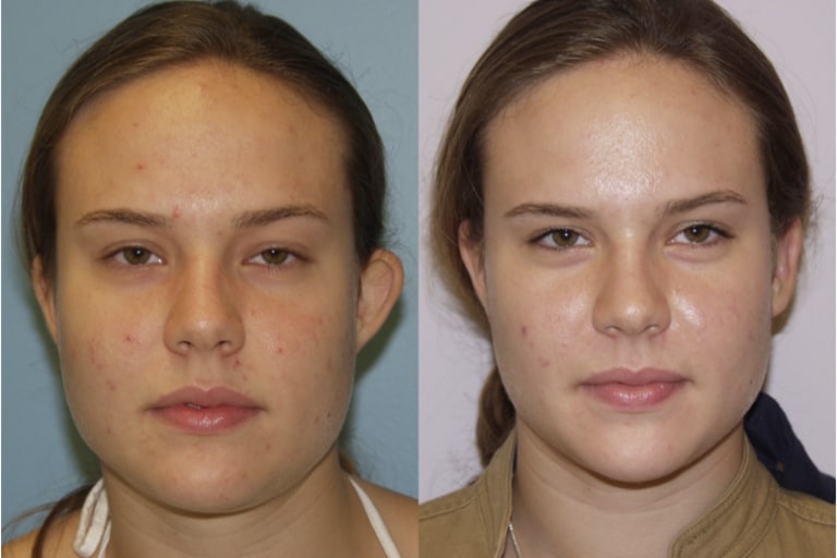 Otoplasty (Ear Pinning Surgery)
