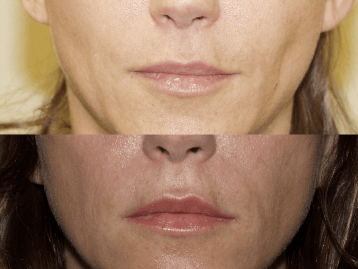 Lip Augmentation & Injection