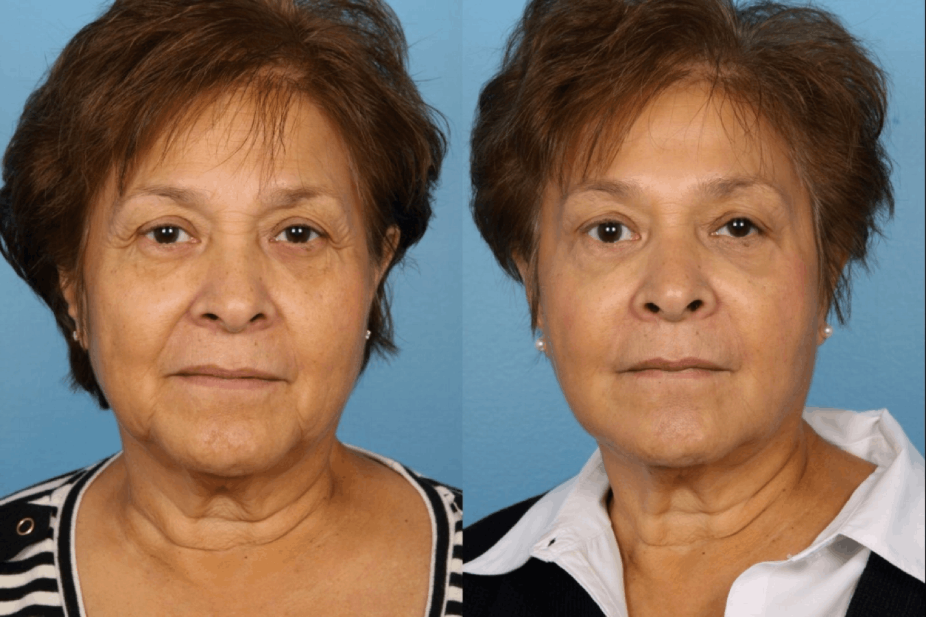 Cosmetic Injectables