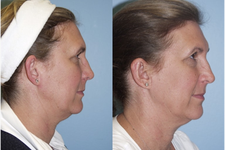 Otoplasty (Ear Pinning Surgery)