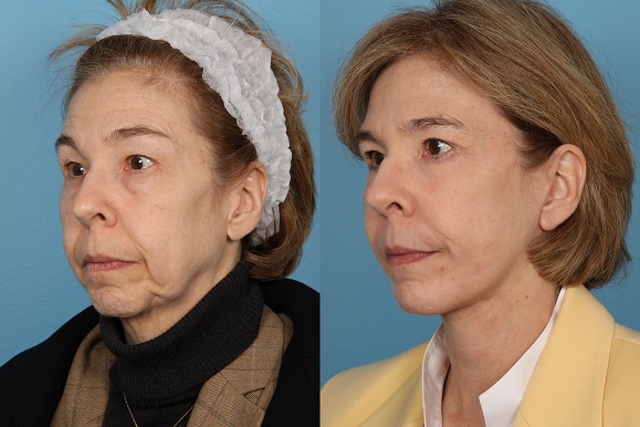 Facelifts and Necklifts