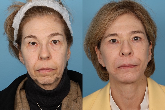Facelifts and Necklifts