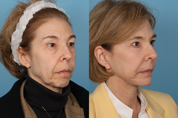 Facelifts and Necklifts
