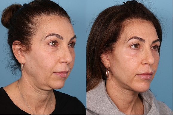 Deep Plane Face and Neck Lift, lower Blephs