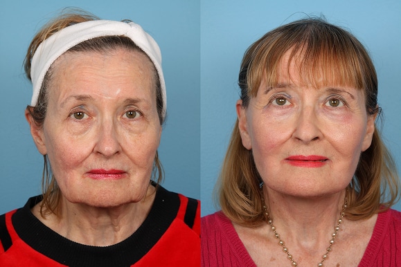 Facelifts and Necklifts