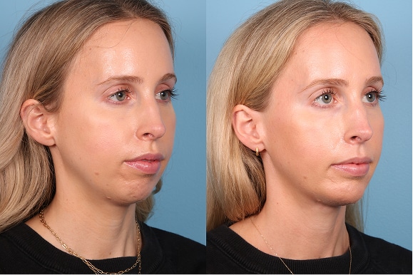 Lower Lid Blephs, Fat grafting to face, chemical peel