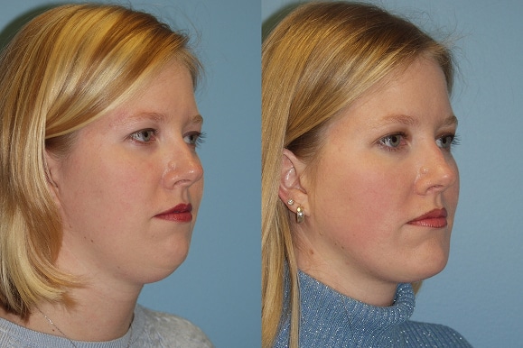 Chin and Submental Liposuction