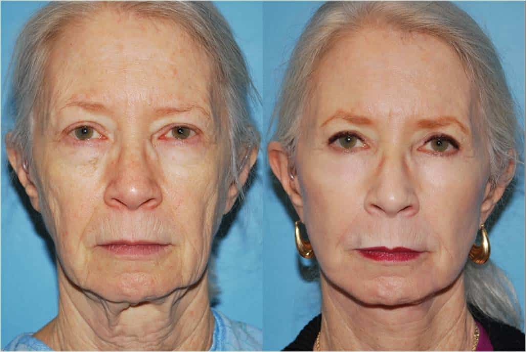 Chemical Peel