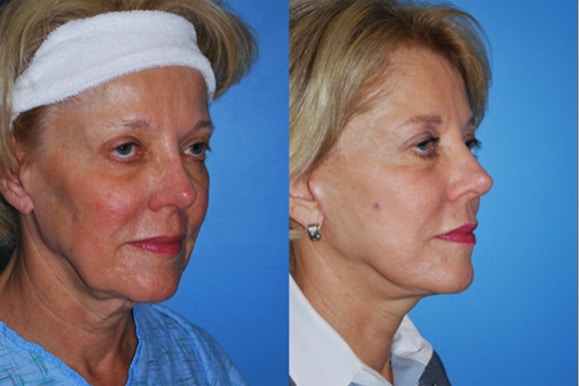 Facelifts and Necklifts
