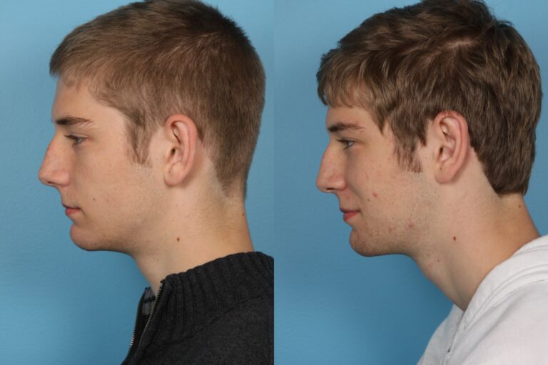 Otoplasy (Ear Pinning)