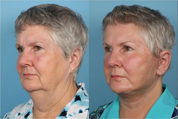 Facelifts and Necklifts