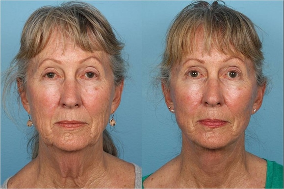 Facelifts and Necklifts