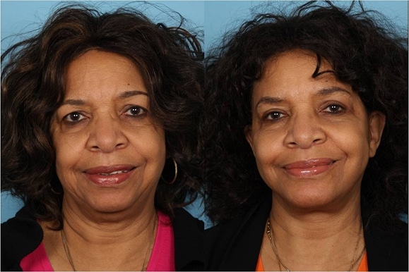 Facelifts and Necklifts
