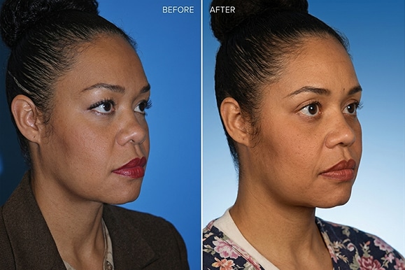 Result-skin-resurfacing